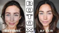 Fröccsenjen a Botox! - Botox partit rendeznek Budapesten