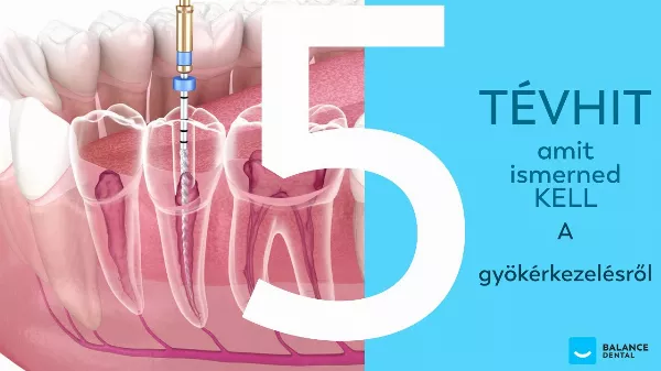 Gyökérkezelés - 5 tévhit aminek nem szabad bedőlnöd!