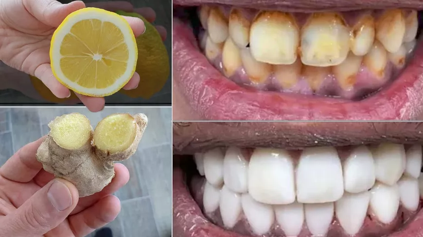 Mindössze 2 perc alatt a sárga piszkos fogak tejfehérré és fényessé válnak - fogászati ​​kezelés otthon
