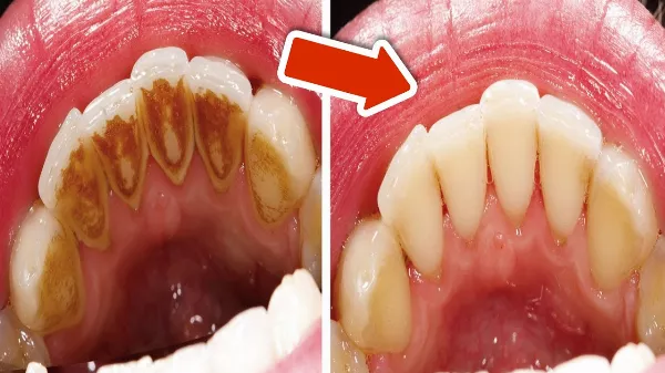 Foglepedék a fogakon: így alakul ki, és így tartható kordában otthon