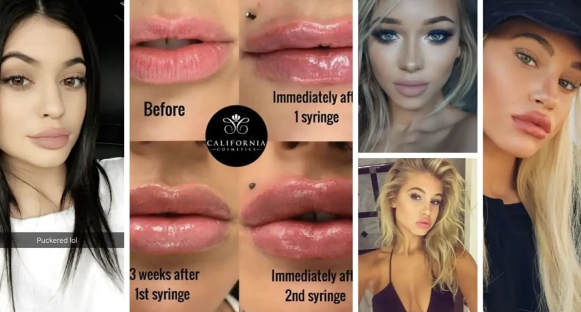 feltötött száj testkép zavar