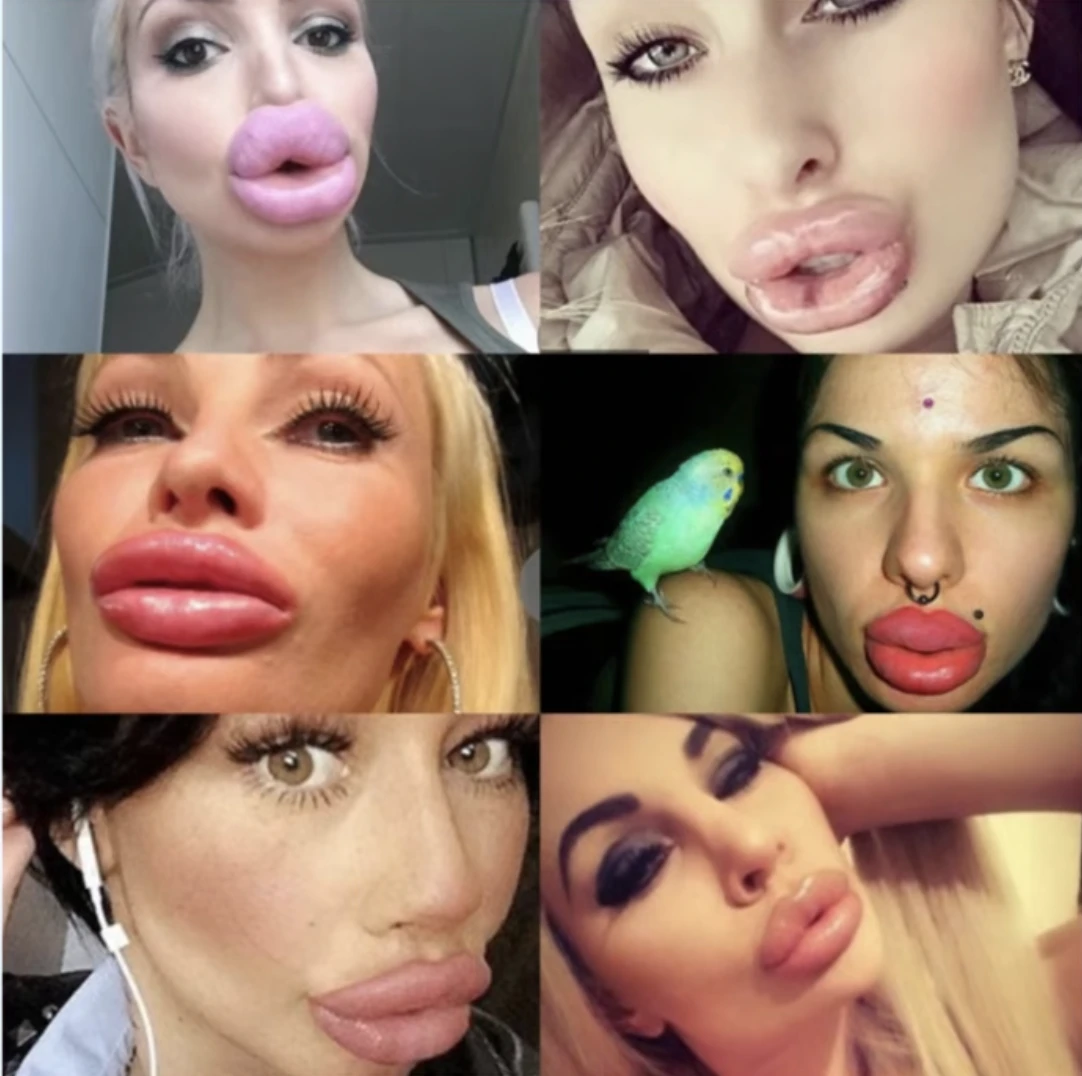 feltöltött száj nők