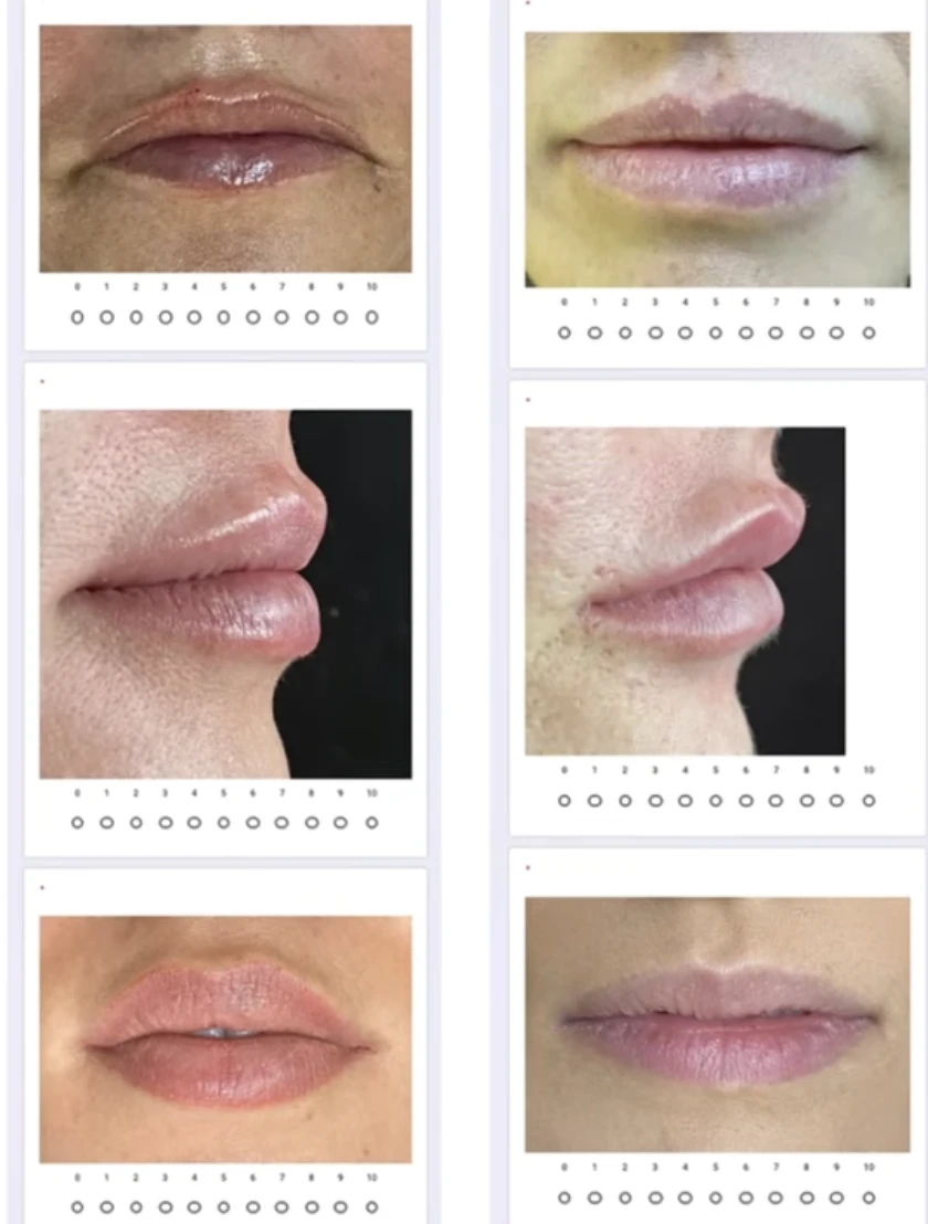 feltöltött száj nők